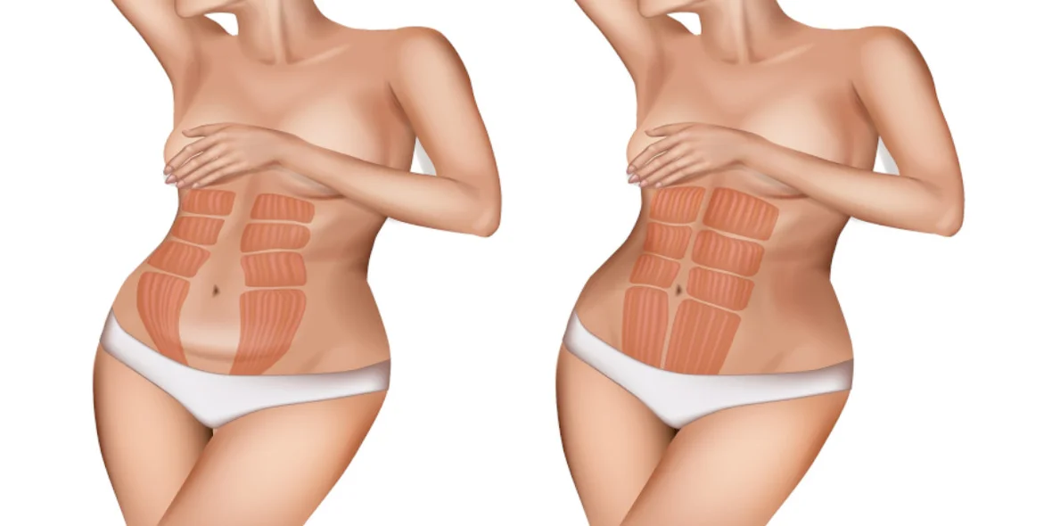 Links Bauchmuskeln nach der Schwangerschaft, rechts Bauchmuskeln nach der Rückbildung